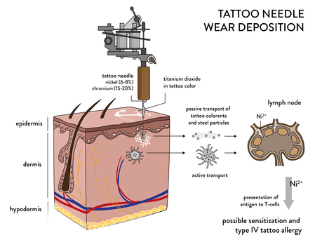 Tatuaggi: allergia provocata dall'ago | Medicina