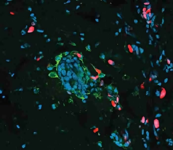 Tumori: cellule tumorali resistenti alla chemioterapia | Biologia
