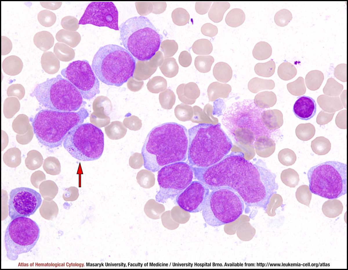 Leucemia mieloide acuta: la causa nelle cellule staminali | Medicina