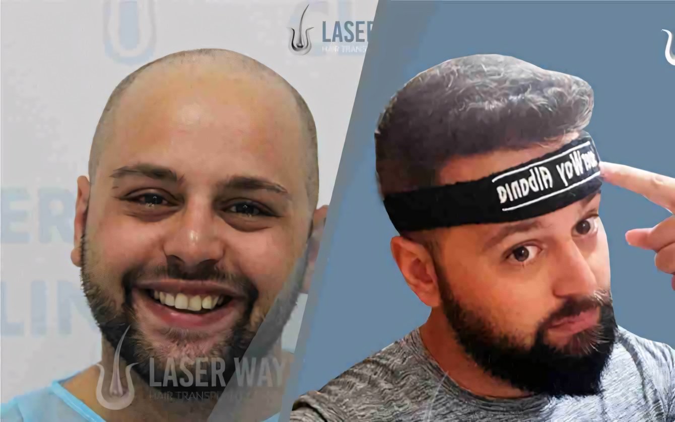 Trapianti di capelli in Albania: perché scegliere Laser Way Clinic